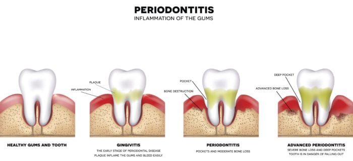 bleeding gums in Rockland County, NY