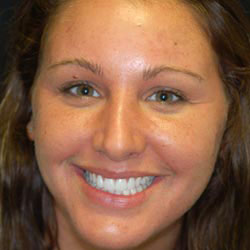 Porcelain veneers for front teeth in Pomona NY; F