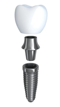 Dental Implants FAQs Pomona, NY