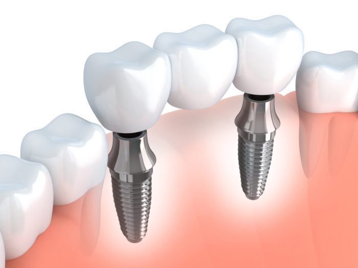 Multiple Dental Implants Pomona, NY
