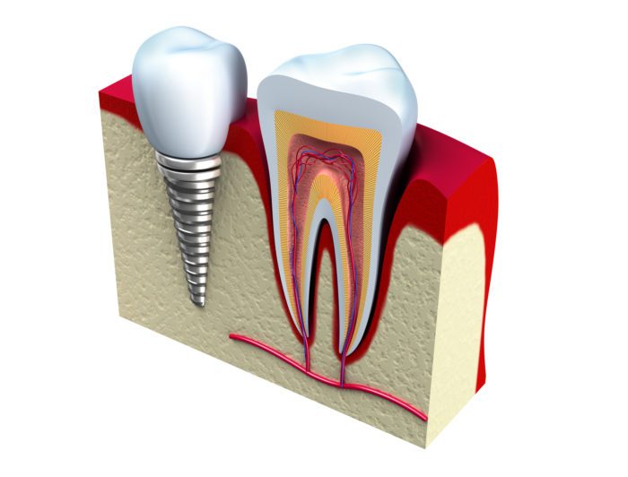 Single Dental Implants Pomona, NY