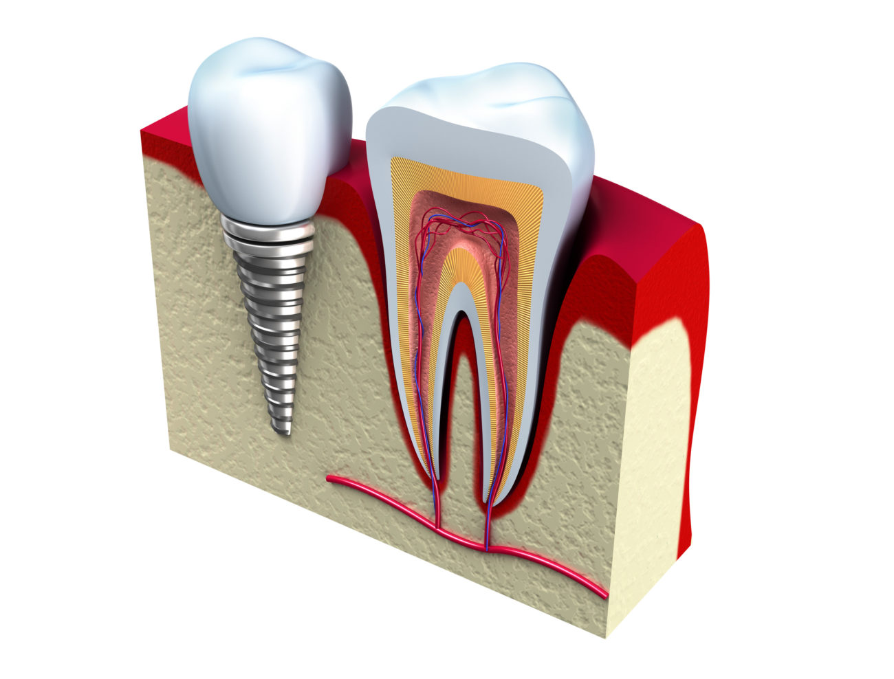Single Dental Implants Pomona NY Tooth Implant