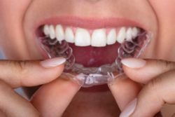 Invisalign in Rockland County NY