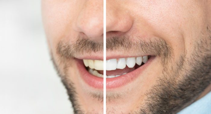 treat discolored teeth in Pomona, New York