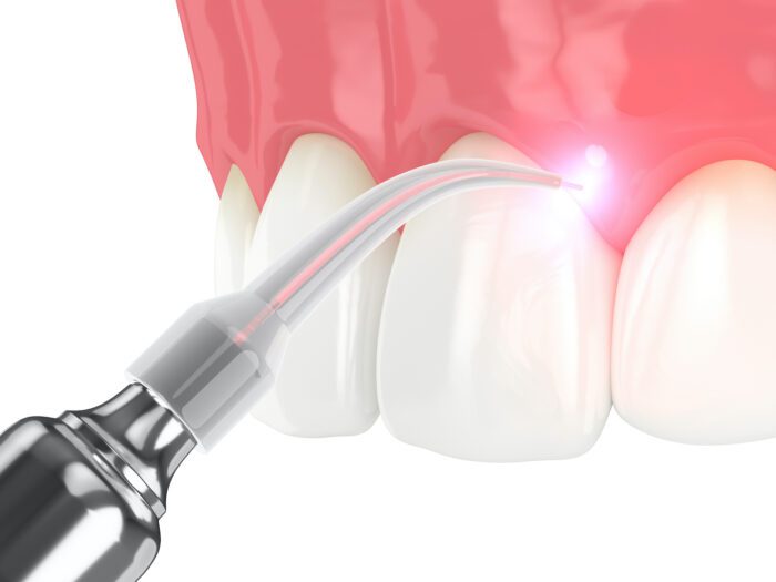 Laser Dentistry in Rockland County NY is a quick and safe treatment option for gum disease