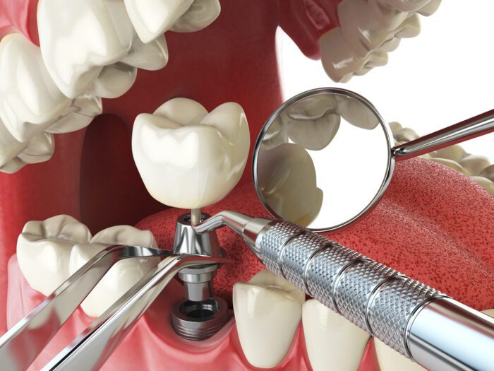 Implant Dentistry in Rockland County NY may not be available for every patient