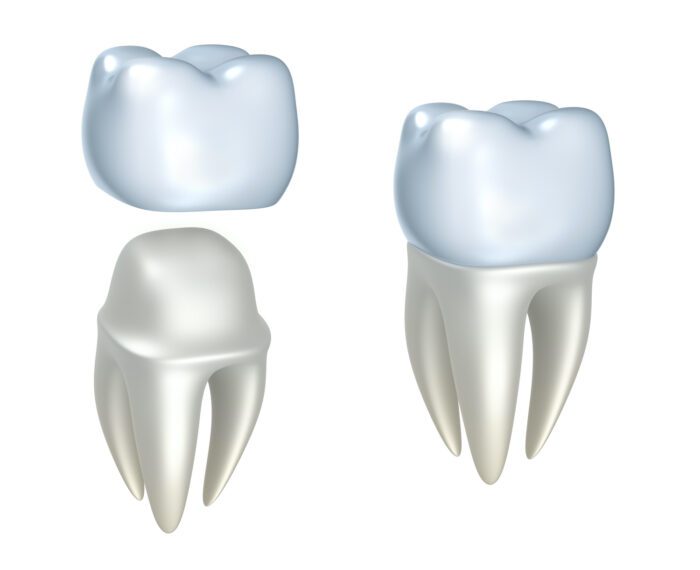A Dental Crown in Rockland County NY could be necessary to provide maximum dental protection