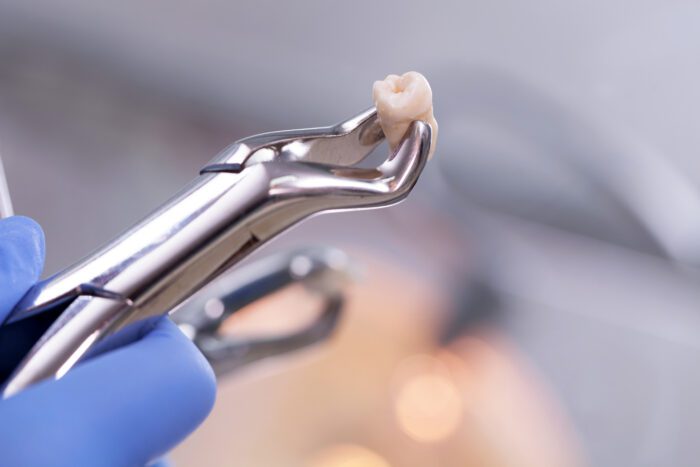 There are several reasons why you might need to have a tooth extraction including extensive tooth decay, overcrowded teeth, or severe infection. 