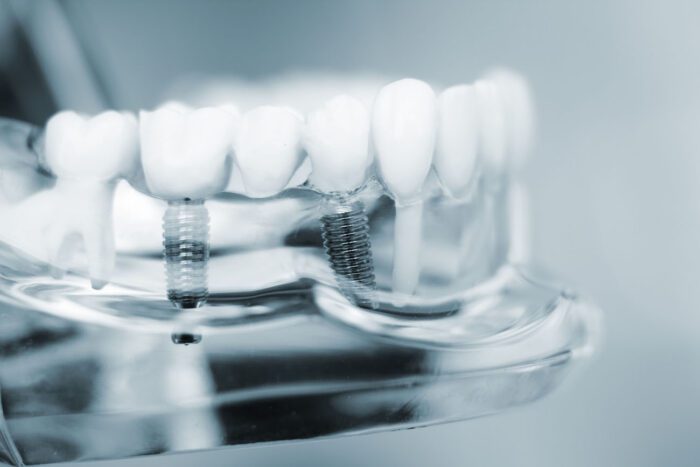 A dental implant offers a durable and long-lasting solution that could restore your smile and improve your bite.