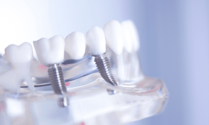 The decision to get multiple dental implants is significant. It requires careful consideration of various factors.