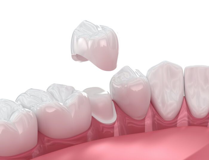Losing a dental crown isn’t usually a dental emergency, but it does require quick and careful action to prevent further complications. 